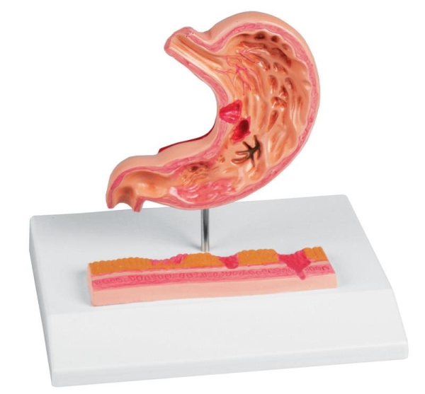 (K217) Stomach with Ulcers