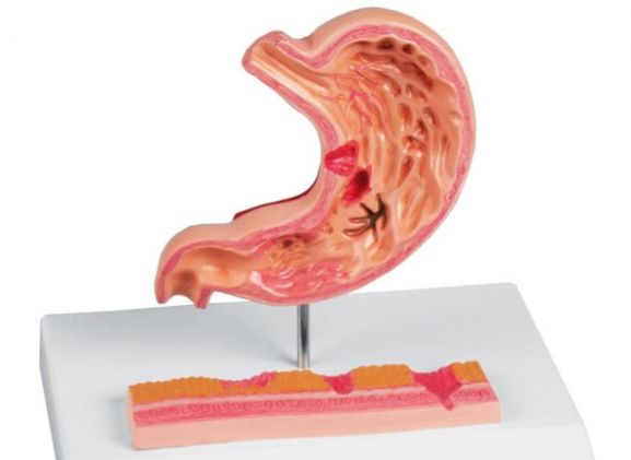 https://www.jayakelana.co.id/uploads/product/-k217-stomach-with-ulcers-69392f48960fe9e_cover.jpg