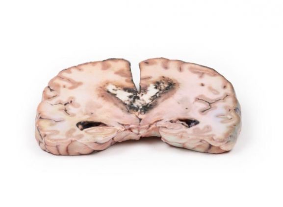 https://www.jayakelana.co.id/uploads/product/-mp2003-glioma-grade-3-4--15959f8d55a3304_cover.jpg