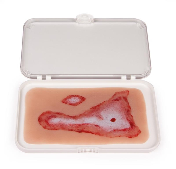 (NW011) Wound Moulage Scalding
