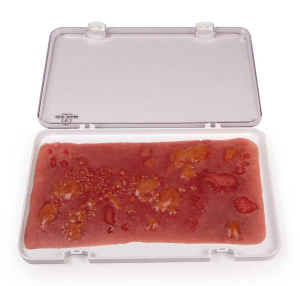 (NW106) Wound Moulage 2nd Degree Burn (big)